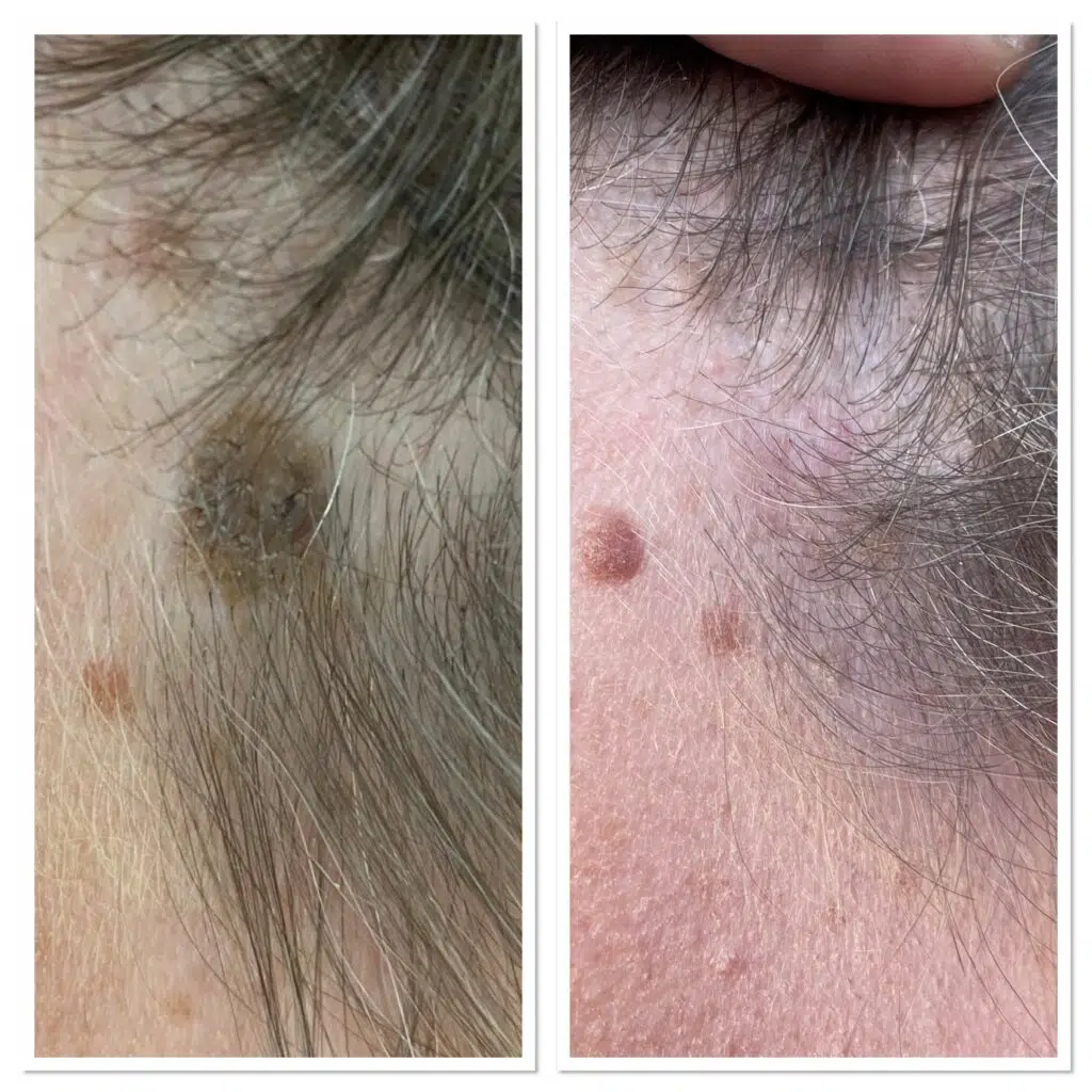 Microsuction ear wax removal East Sussex